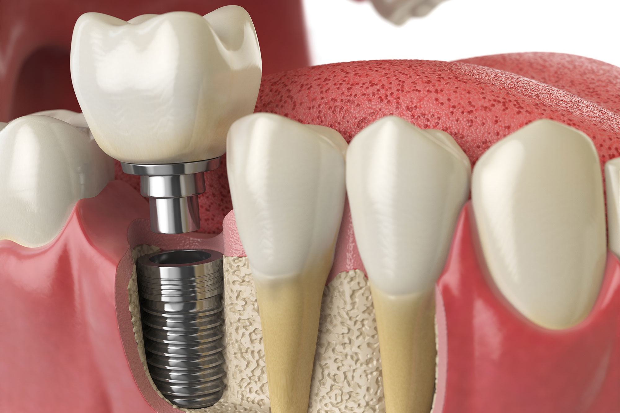 Dental Implants - [city], [state]